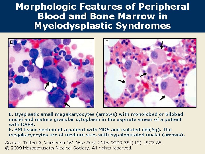 Morphologic Features of Peripheral Blood and Bone Marrow in Myelodysplastic Syndromes E F E.