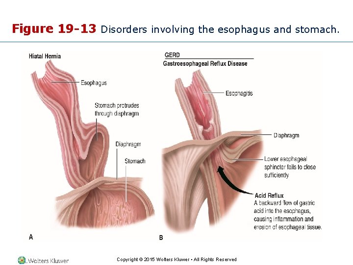 Figure 19 -13 Disorders involving the esophagus and stomach. Copyright © 2015 Wolters Kluwer