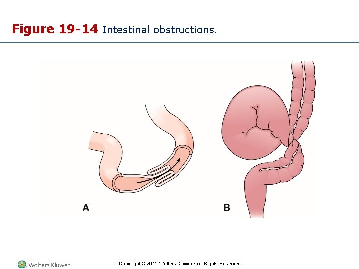 Figure 19 -14 Intestinal obstructions. Copyright © 2015 Wolters Kluwer • All Rights Reserved