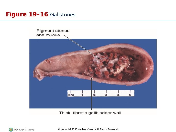 Figure 19 -16 Gallstones. Copyright © 2015 Wolters Kluwer • All Rights Reserved 