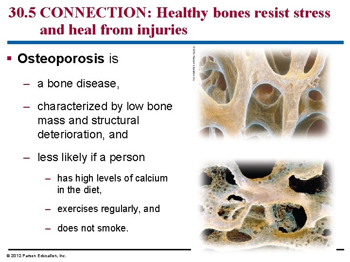 30. 5 CONNECTION: Healthy bones resist stress and heal from injuries § Osteoporosis is