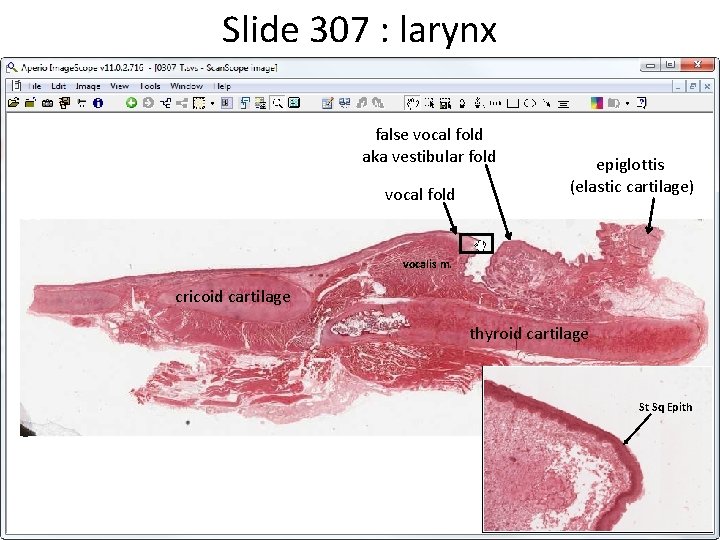 Slide 307 : larynx false vocal fold aka vestibular fold vocal fold epiglottis (elastic