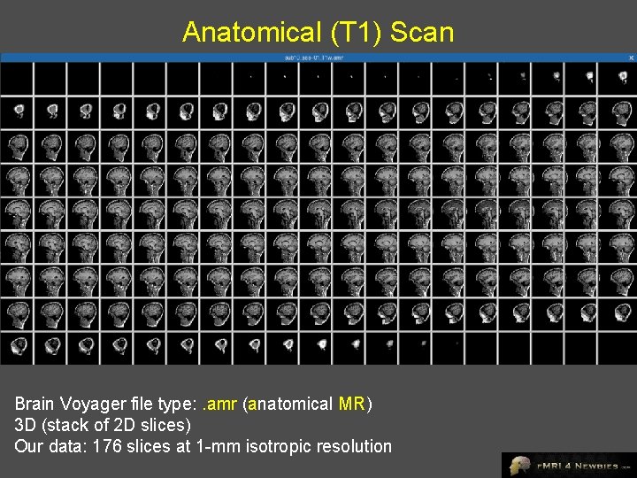 Anatomical (T 1) Scan Brain Voyager file type: . amr (anatomical MR) 3 D