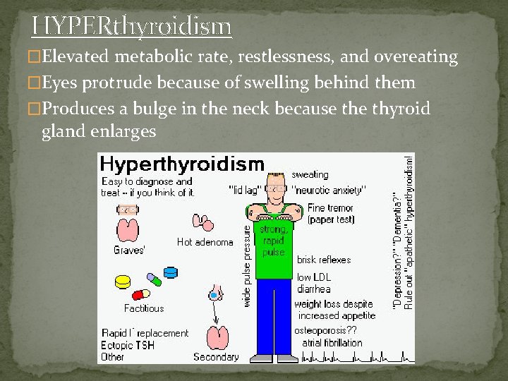HYPERthyroidism �Elevated metabolic rate, restlessness, and overeating �Eyes protrude because of swelling behind them