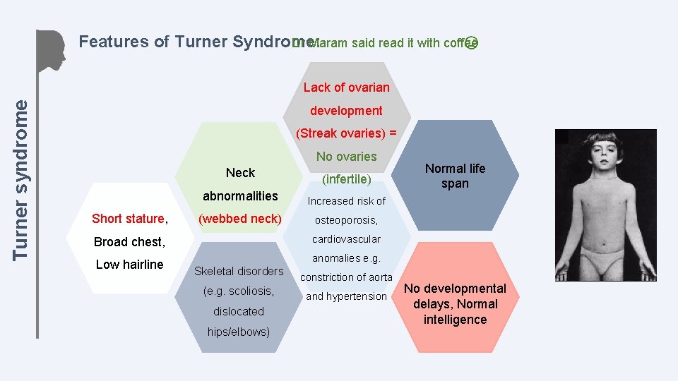 Features of Turner Syndrome: Dr Maram said read it with coffee Turner syndrome Lack