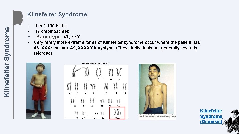 Klinefelter Syndrome • • 1 in 1, 100 births. 47 chromosomes. • Karyotype: 47,