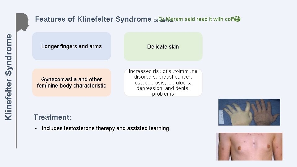 Klinefelter Syndrome Dr Maram said read it with coffee Features of Klinefelter Syndrome Continued…