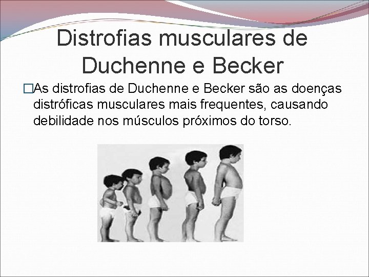 Distrofias musculares de Duchenne e Becker �As distrofias de Duchenne e Becker são as