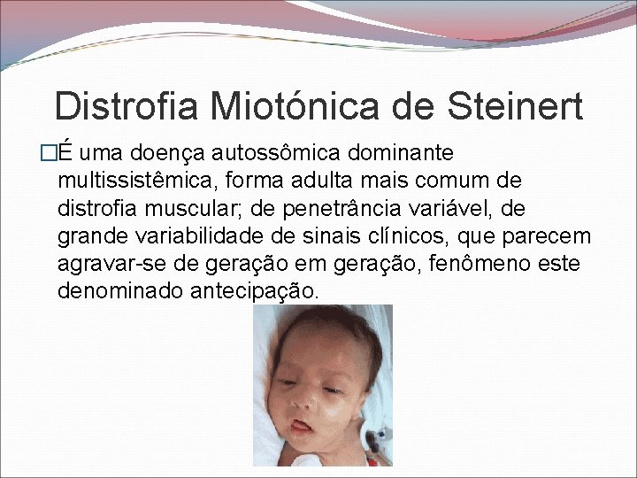 Distrofia Miotónica de Steinert �É uma doença autossômica dominante multissistêmica, forma adulta mais comum