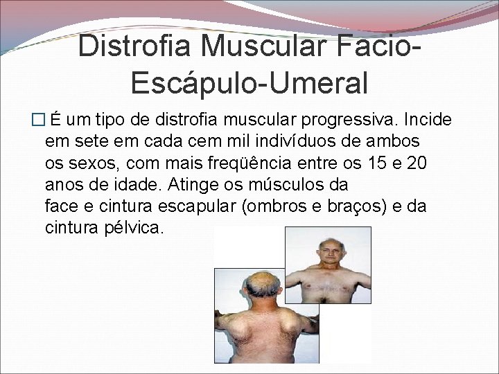 Distrofia Muscular Facio. Escápulo-Umeral � É um tipo de distrofia muscular progressiva. Incide em