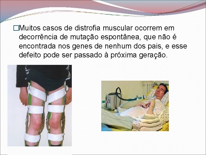 �Muitos casos de distrofia muscular ocorrem em decorrência de mutação espontânea, que não é