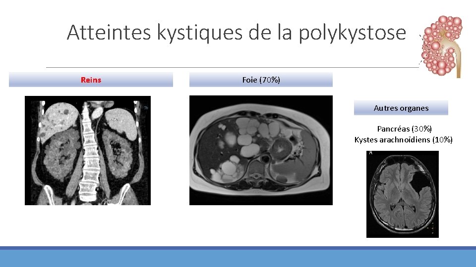 Atteintes kystiques de la polykystose Reins Foie (70%) Autres organes Pancréas (30%) Kystes arachnoïdiens