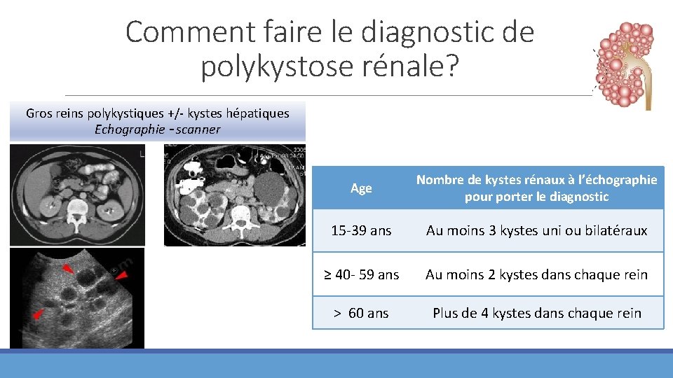 Comment faire le diagnostic de polykystose rénale? Gros reins polykystiques +/- kystes hépatiques Echographie