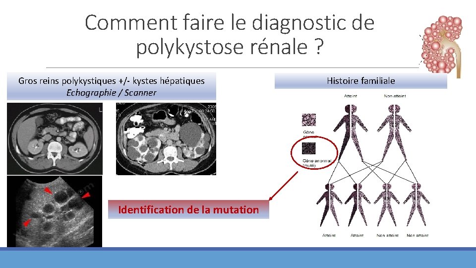 Comment faire le diagnostic de polykystose rénale ? Gros reins polykystiques +/- kystes hépatiques