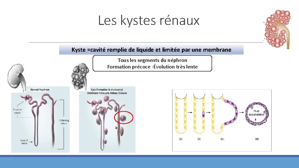 Les kystes rénaux Kyste =cavité remplie de liquide et limitée par une membrane Tous