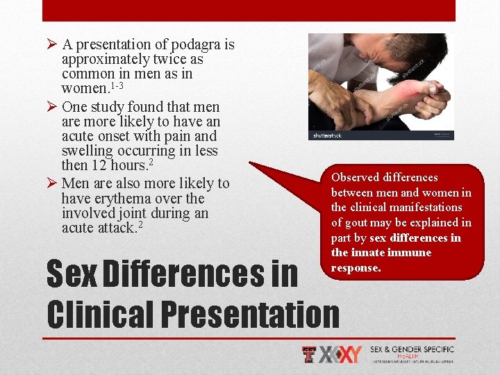 Ø A presentation of podagra is approximately twice as common in men as in