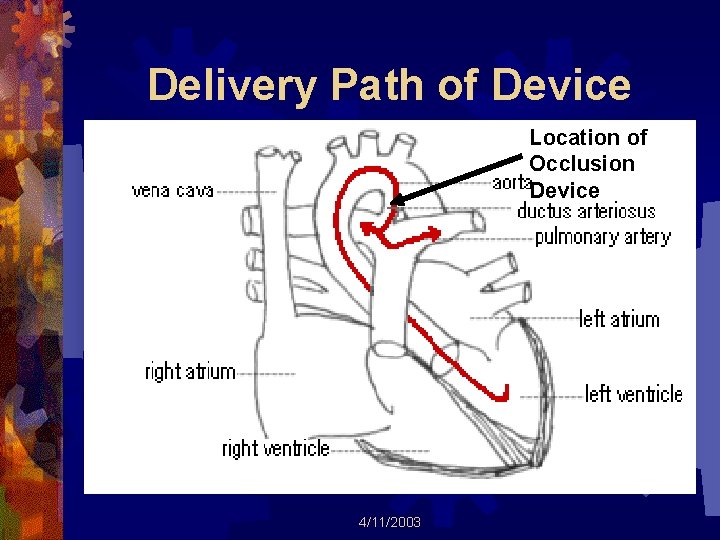 Delivery Path of Device Location of Occlusion Device 4/11/2003 