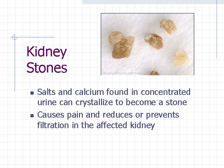 Kidney Stones n n Salts and calcium found in concentrated urine can crystallize to