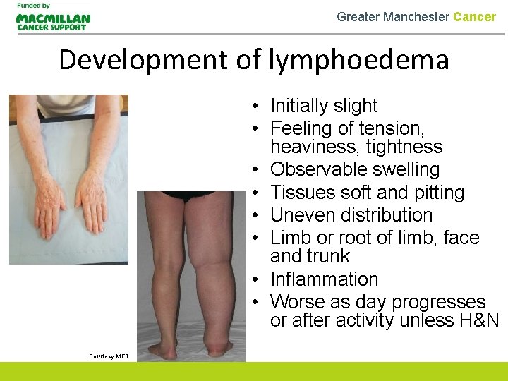 Greater Manchester Cancer Development of lymphoedema • Initially slight • Feeling of tension, heaviness,