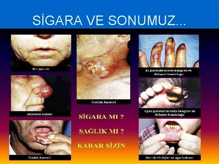 SİGARA VE SONUMUZ. . . 