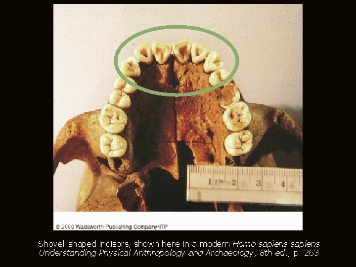 Shovel-shaped incisors, shown here in a modern Homo sapiens Understanding Physical Anthropology and Archaeology,