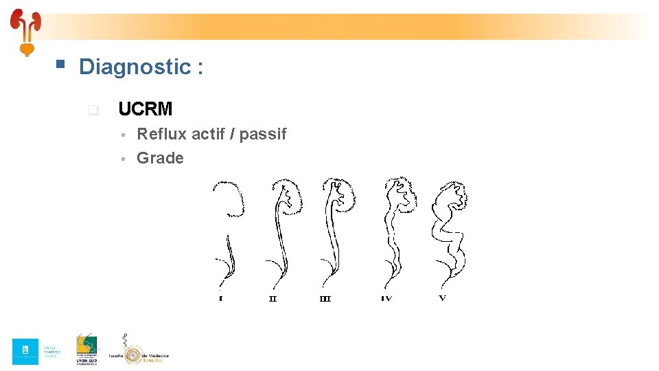 § Diagnostic : q UCRM § § Reflux actif / passif Grade 