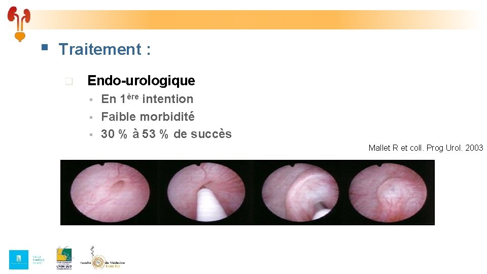 § Traitement : q Endo-urologique § § § En 1ère intention Faible morbidité 30