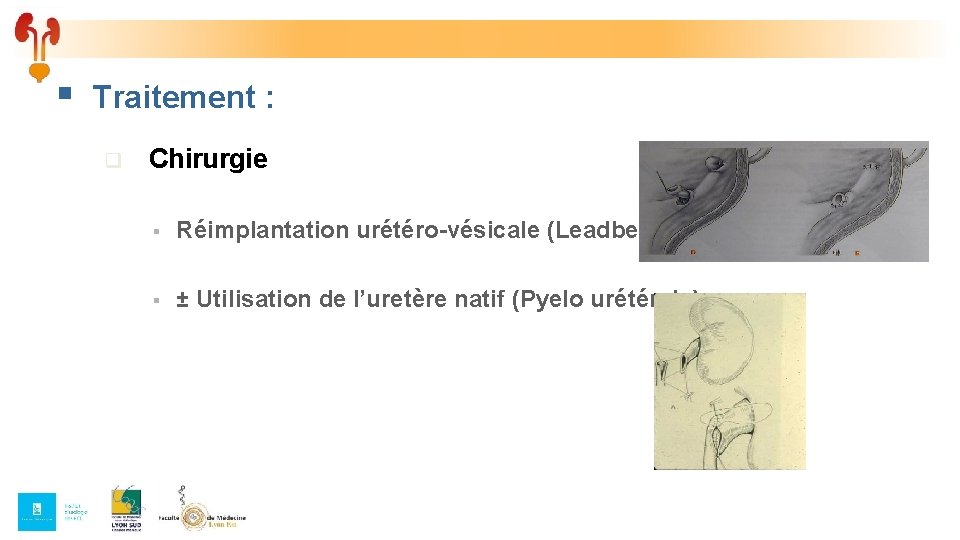 § Traitement : q Chirurgie § Réimplantation urétéro-vésicale (Leadbetter) § ± Utilisation de l’uretère