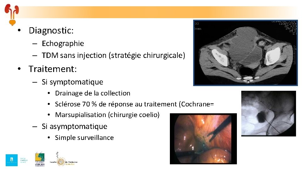 • Diagnostic: – Echographie – TDM sans injection (stratégie chirurgicale) • Traitement: – • Diagnostic: – Echographie – TDM sans injection (stratégie chirurgicale) • Traitement: –