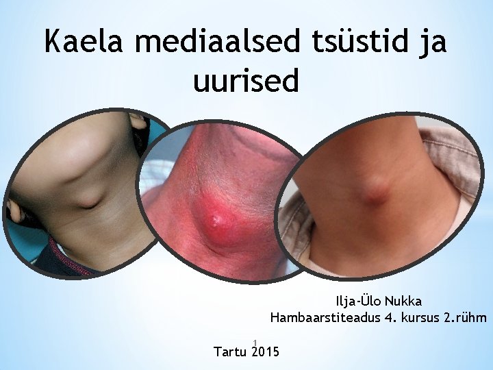 Kaela mediaalsed tsüstid ja uurised Ilja-Ülo Nukka Hambaarstiteadus 4. kursus 2. rühm 1 Tartu