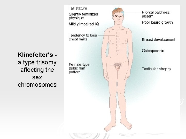 Klinefelter’s a type trisomy affecting the sex chromosomes Klinefelter’s a type trisomy affecting the sex chromosomes