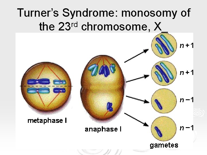 Turner’s Syndrome: monosomy of the 23 rd chromosome, X_ Turner’s Syndrome: monosomy of the 23 rd chromosome, X_