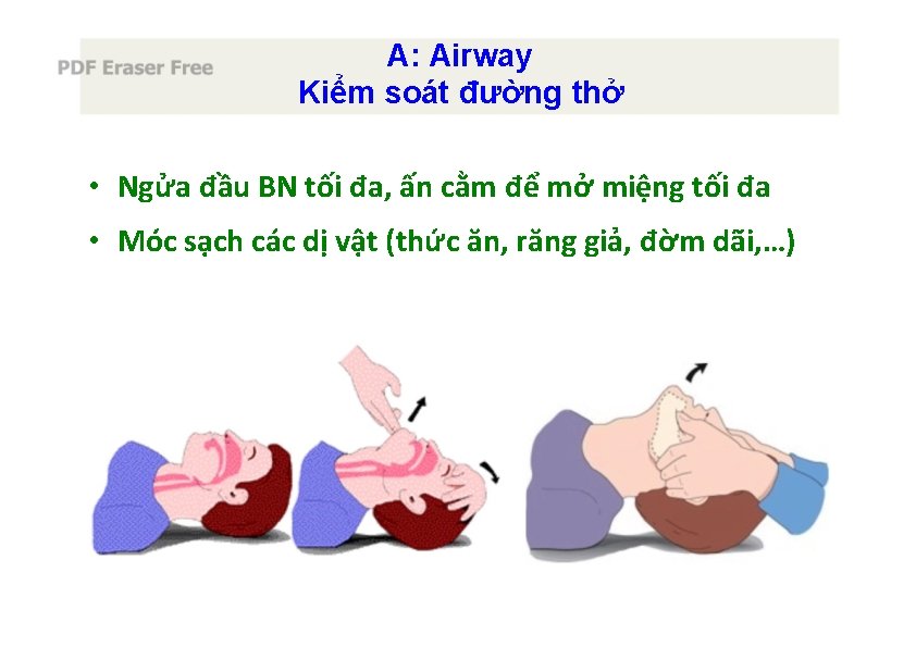 A: Airway Kiểm soát đường thở • Ngửa đầu BN tối đa, ấn cằm