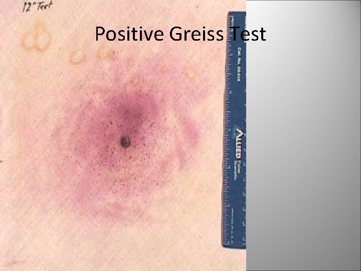 Positive Greiss Test 