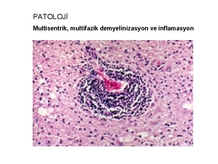PATOLOJİ Multisentrik, multifazik demyelinizasyon ve inflamasyon 