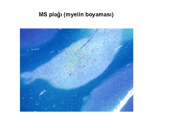 MS plağı (myelin boyaması) 