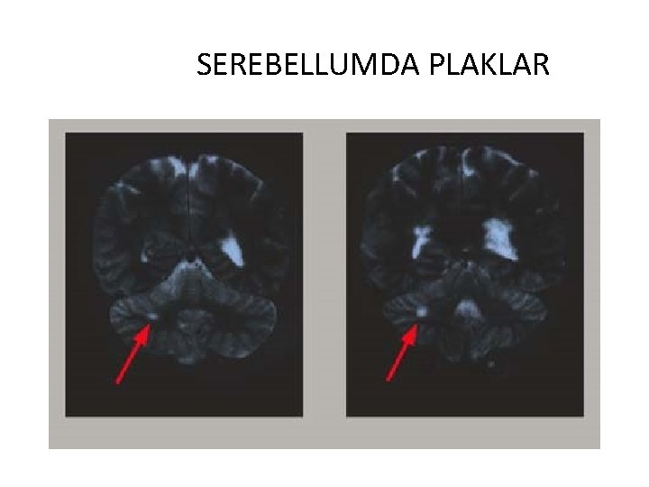 SEREBELLUMDA PLAKLAR 