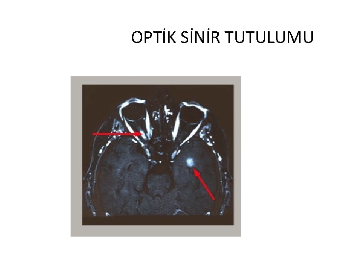 OPTİK SİNİR TUTULUMU 