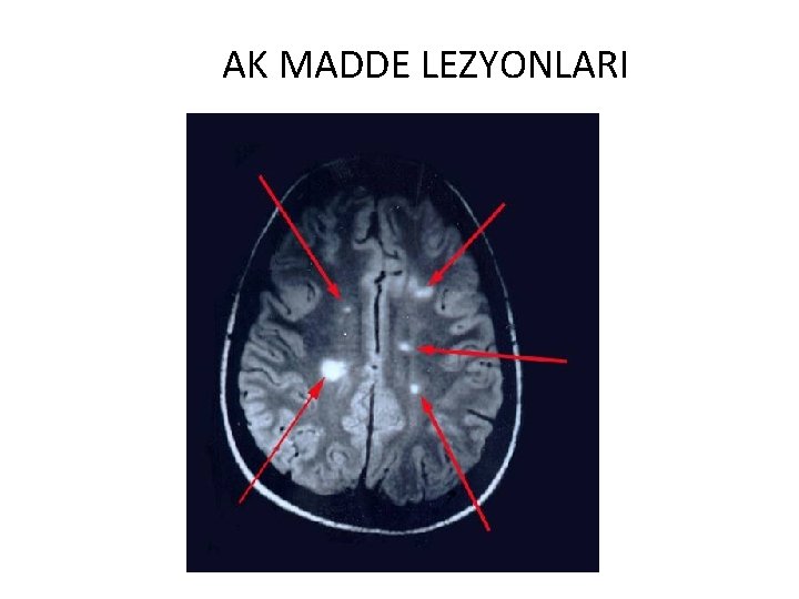 AK MADDE LEZYONLARI 