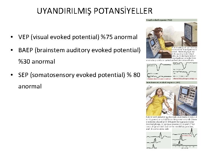 UYANDIRILMIŞ POTANSİYELLER • VEP (visual evoked potential) %75 anormal • BAEP (brainstem auditory evoked