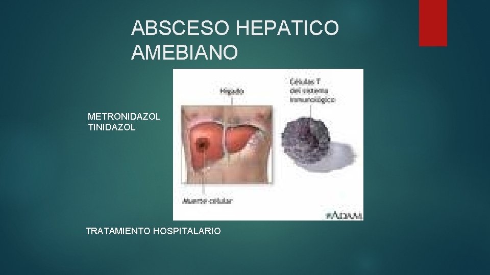 ABSCESO HEPATICO AMEBIANO METRONIDAZOL TINIDAZOL TRATAMIENTO HOSPITALARIO 