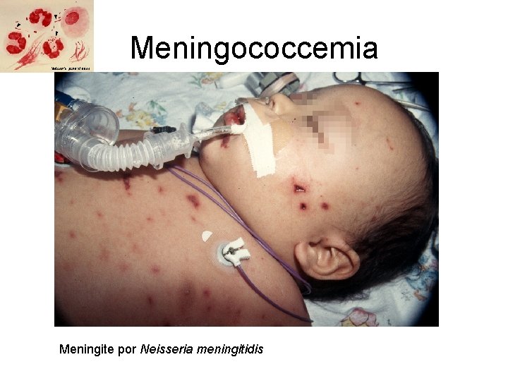 Meningococcemia Meningite por Neisseria meningitidis 