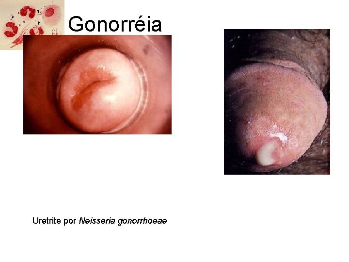 Gonorréia Uretrite por Neisseria gonorrhoeae 