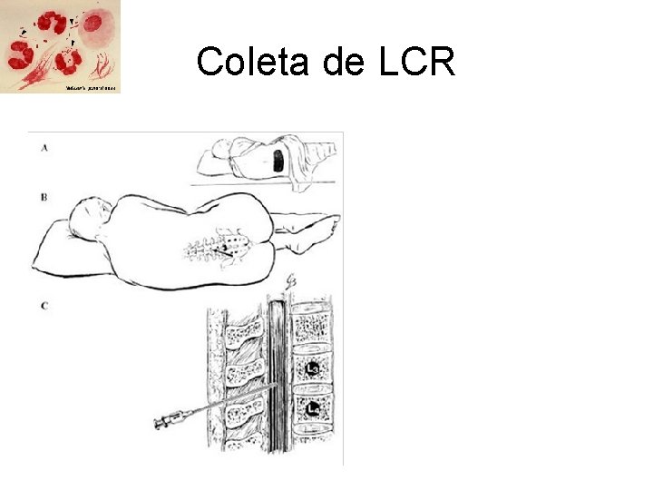 Coleta de LCR 