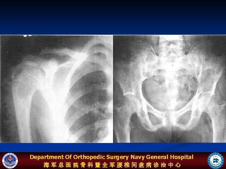 Department Of Orthopedic Surgery Navy General Hospital 海军总医院骨科暨全军腰椎间盘病诊治中心 