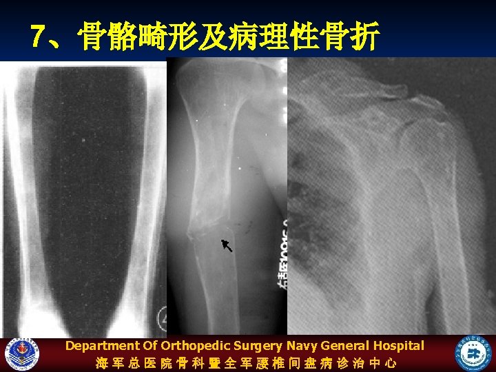 7、骨骼畸形及病理性骨折 Department Of Orthopedic Surgery Navy General Hospital 海军总医院骨科暨全军腰椎间盘病诊治中心 