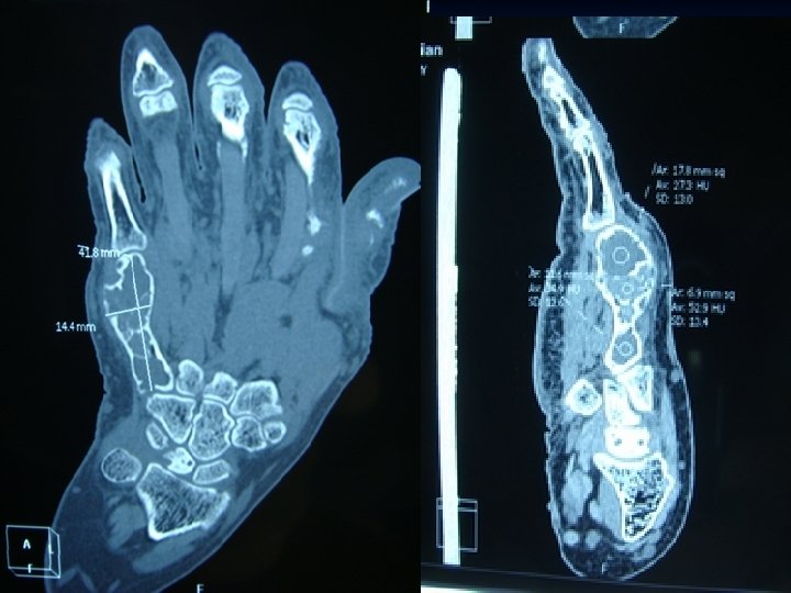 Department Of Orthopedic Surgery Navy General Hospital 海军总医院骨科暨全军腰椎间盘病诊治中心 