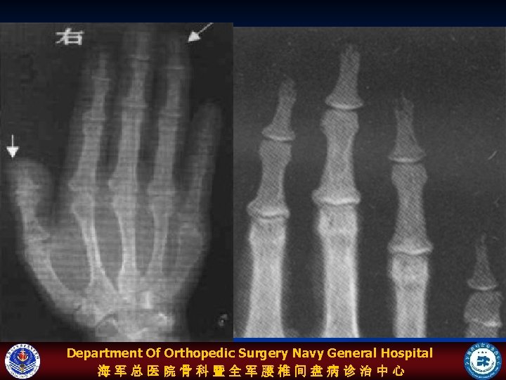 Department Of Orthopedic Surgery Navy General Hospital 海军总医院骨科暨全军腰椎间盘病诊治中心 