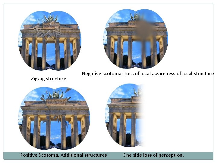 Zigzag structure Negative scotoma. Loss of local awareness of local structure Positive Scotoma. Additional