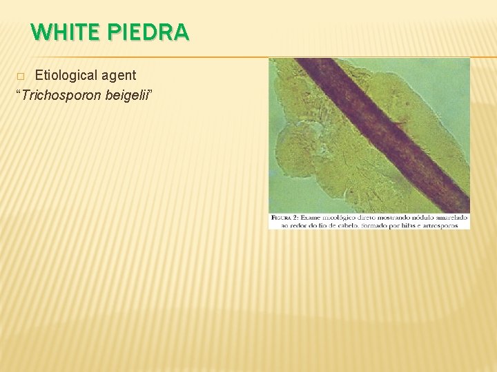 WHITE PIEDRA Etiological agent “Trichosporon beigelii” � 